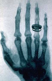 Рентгеновский снимок руки Альберта фон Кёликера, сделанный Рентгеном.jpg